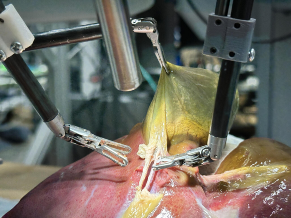 Autonomous Robot Surgeon Removes Gallbladder Unaided